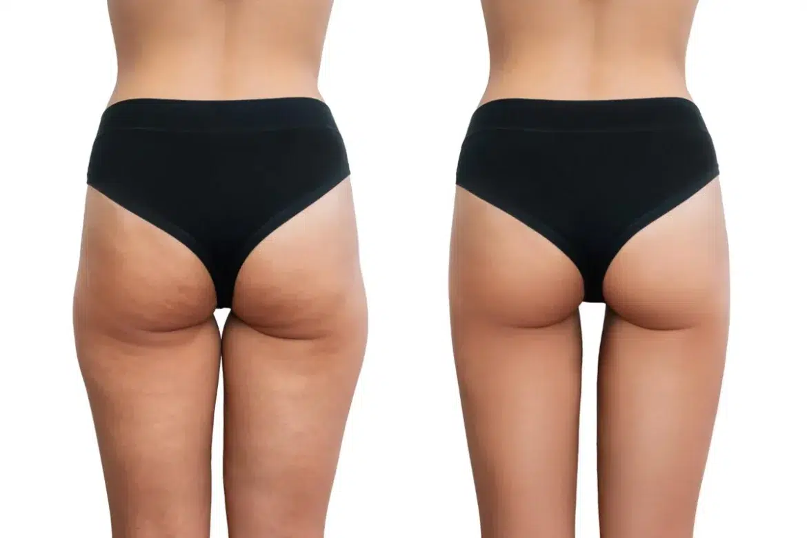 antes e depois Dimpless